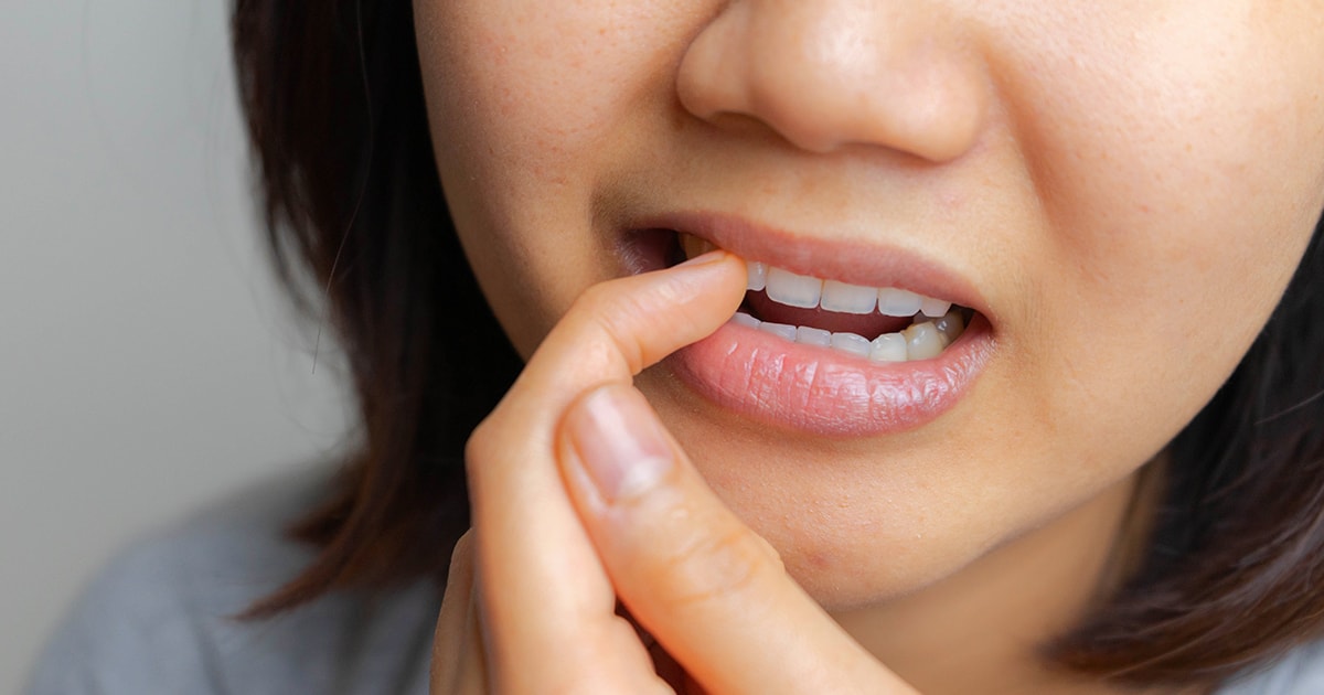 Fissures dentaires : 5 conseils pour prévenir les fissures - dentiste ste therese